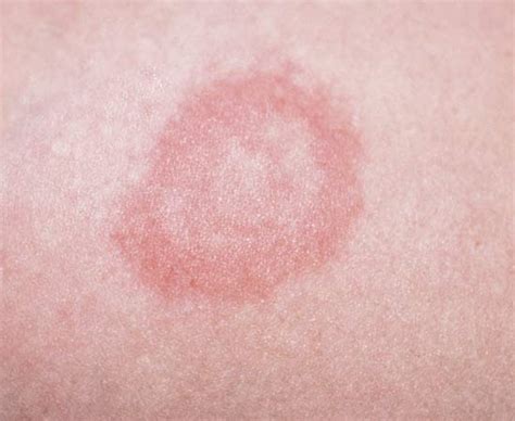 The Characteristic Bullseye Rash For Lyme Disease Innatoss