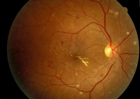 Clinically Significant Macular Edema