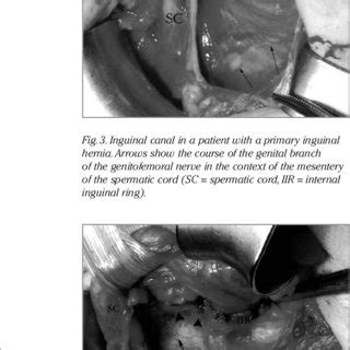 The figure depicts the inguinal canal in a patient with a recurrent... | Download Scientific Diagram