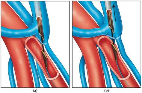 Diagnostics Free Full Text Endovascular Arteriovenous Fistula