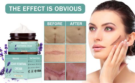 Buy Top Selling Scar Removal Cream Effective For Ance Scars Surgery