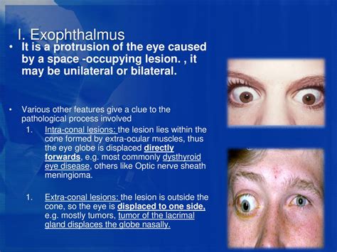 Exophthalmos Unilateral