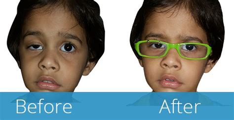 Buy Special Ptosis Eye Crutch Glasses In India Artificial Eye Co