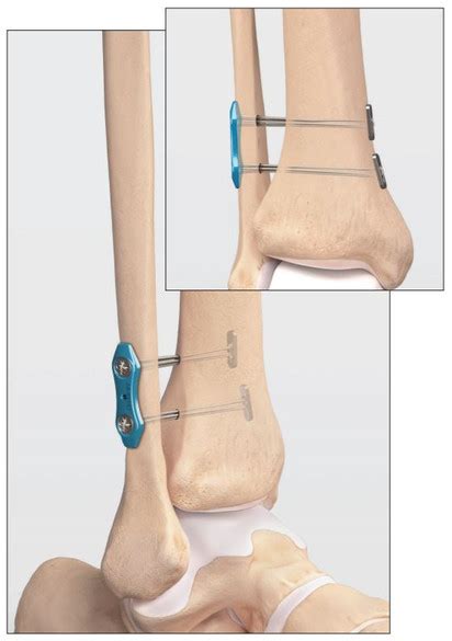 Dual Syndesmosis Tightrope Wasatch Foot And Ankle