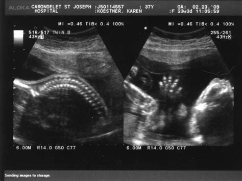 Ultrasound 23 Weeks Twin B039 Flickr Photo Sharing