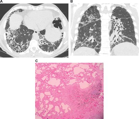 Scielo Brasil Imaging In Idiopathic Pulmonary Fibrosis Diagnosis