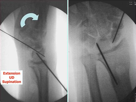 Minimal Invasive Management Of Scaphoid Fractures From Fresh To