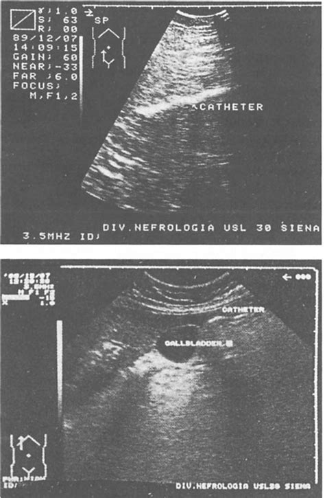 Scansione Longitudinale Ipocondrio Destro Catetere Peritoneale