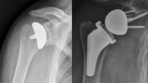 Decoding Total Shoulder Replacements: Anatomic vs. Reverse | OMGTB