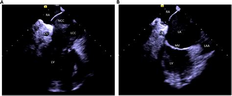 Frontiers Understanding The Scope Of Intracardiac Echocardiography In