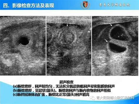 坏死性小肠结肠炎的影像特征分析肠壁缺乏门静脉 健康界