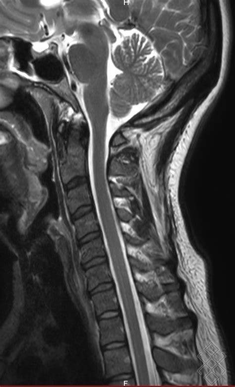 Irm Du Rachis Cervical D Finition D Roulement Prise De Rdv En Ligne