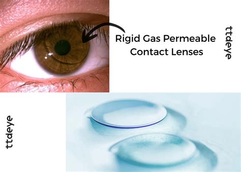 Can I Wear Contact Lenses When I Have Astigmatism? - TTDEYE