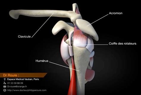 Rupture de la coiffe des rotateurs diagnostic et opération à Paris