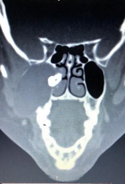 Ct Scan Of The Paranasal Sinuses Showed A Well Defined Solitary