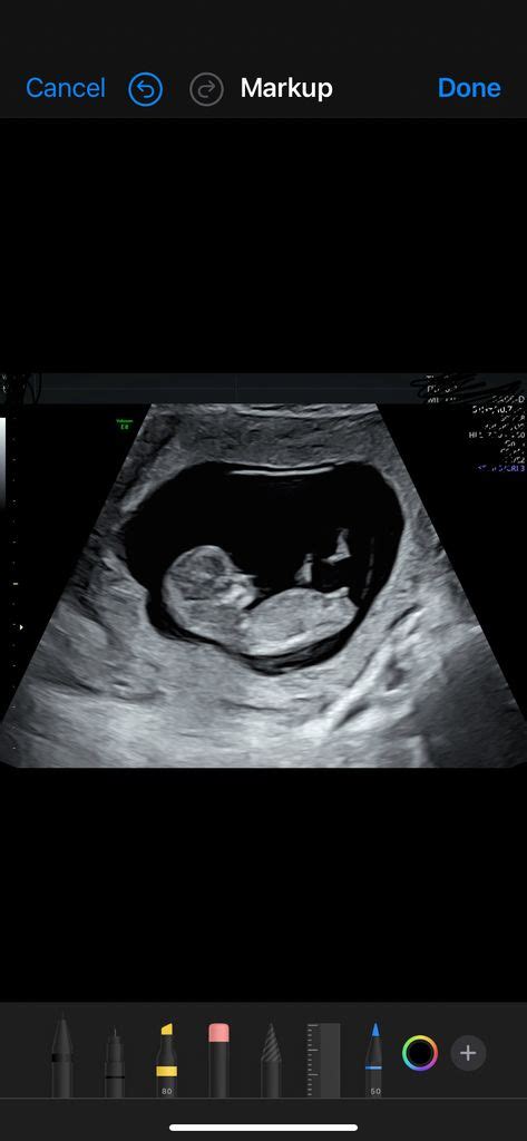 10 Week Ultrasound - August 2024 Babies | Forums | What to Expect