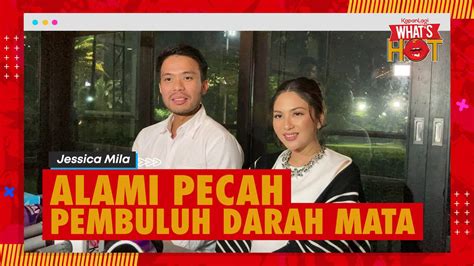 Hamil 4 Bulan Jessica Mila Alami Pecah Pembuluh Darah Di Mata Wajah