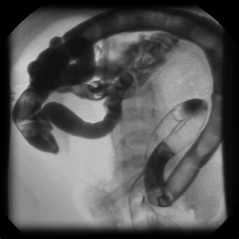 Meconium ileus - wikidoc