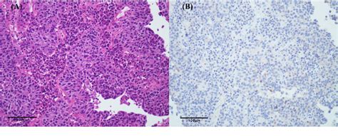 Figure From Neoadjuvant Therapy With Disitamab Vedotin In Treating