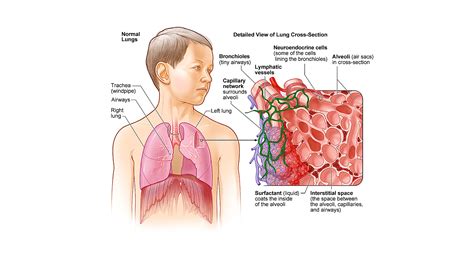 Interstitial Lung Disease Symptoms And Causes Mayo Clinic 50 Off