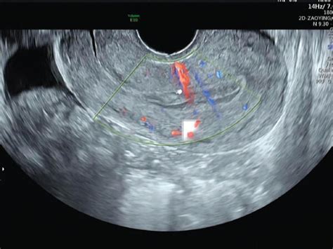 Female 32 Years Old A Endometrial Polyp Seen On Vaginal Ultrasound