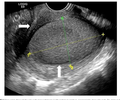 Ultrasound Guided Transvaginal Aspiration And Sclerotherapy For Uterine