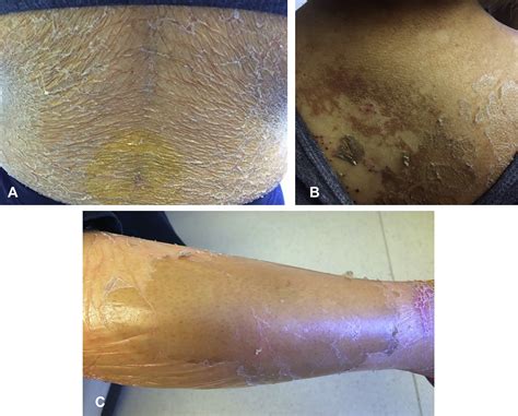 “Peeling paint” dermatosis in a leukemia patient - JAAD Case Reports