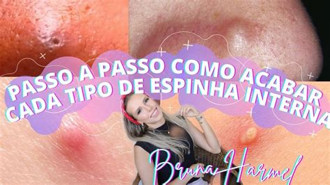 Espinha Interna Como Tirar