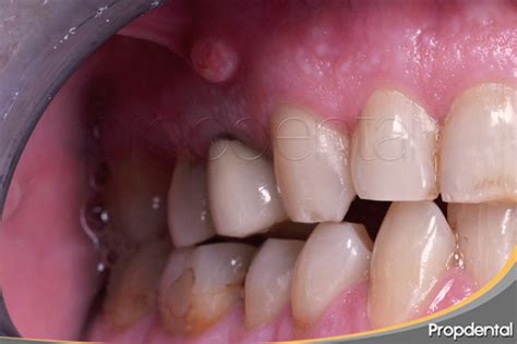 Fístula en la encía Qué es y tratamiento de la Fístula dental