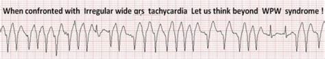 Atrial Fibrillation With Wide Qrs Tachycardia Dont Get Obsessed With