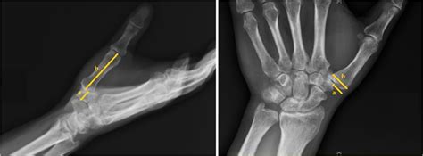 Carpometacarpal Joint Anatomy