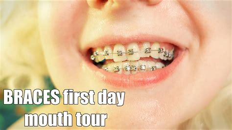 Braces First Day Mouth Tour Close Up Youtube