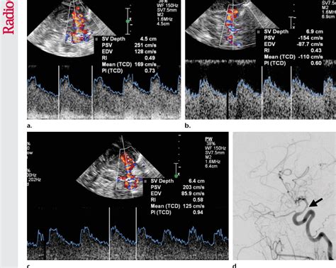 Figure From Advances In Transcranial Doppler Us Imaging Ahead