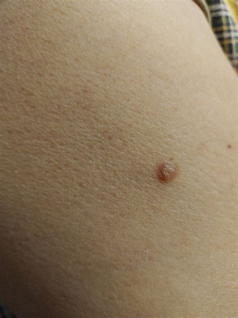 Зуд и воспаление. Разрешите вопрос - Вопрос дерматологу - 03 Онлайн