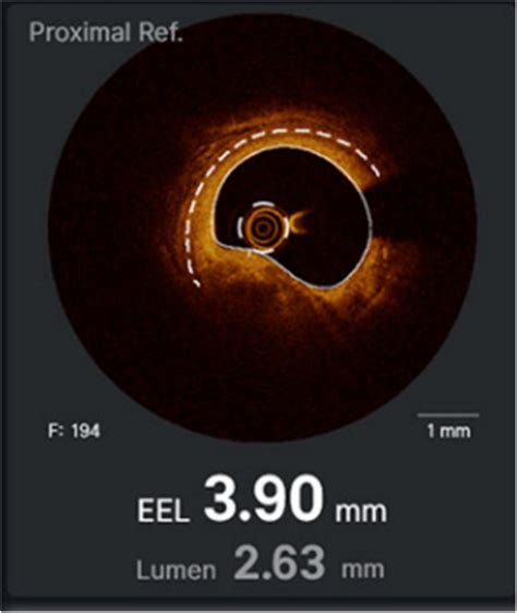 Frontiers Intravascular Imaging In Coronary Stent Restenosis