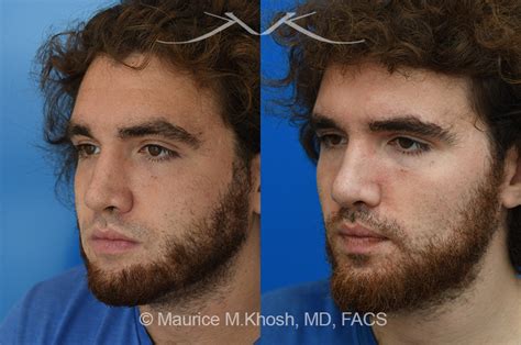 New York Facial Plastic Surgery Revision Rhinoplasty Before And After