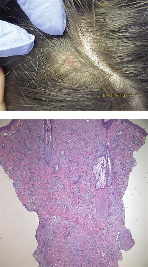 Figure 2 From A Case Of A Cellular Neurothekeoma Presenting With Headaches And Review Of The