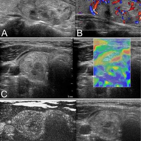 A The Isoechoic Solid Nodule With A Regular Thin Halo Was Evaluated