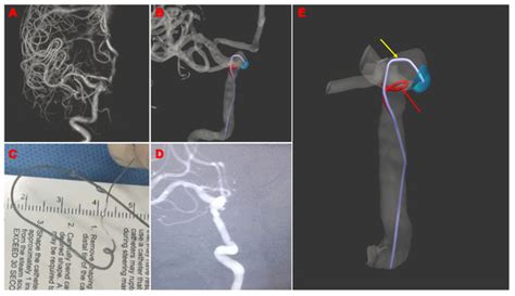 Brain Sciences Free Full Text Computer Assisted Microcatheter