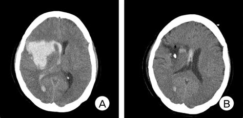 Preoperative Brain Ct Shows A Large Amount Of Intracerebral Hemorrhage