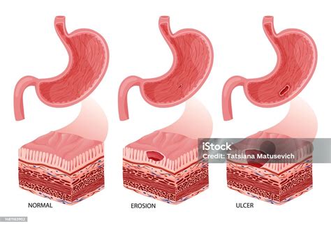 Stomach Erosion And Ulcer Development Illustration Stock Illustration Download Image Now