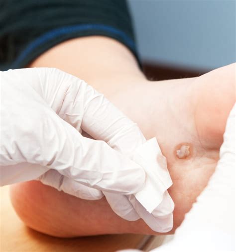 Wart Removal Mclean Potomac Dermatology