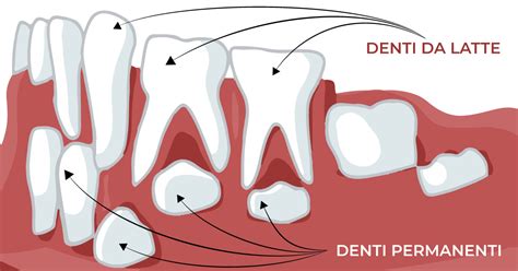 Denti Da Latte Cosa Succede Se Non Cadono SpazioDental