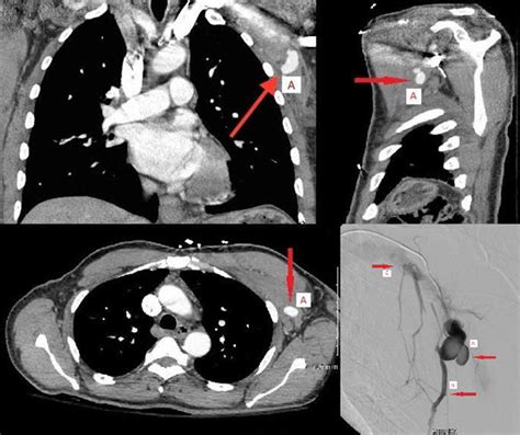 Lateral Thoracic Artery Pseudoaneurysm As A Result Of Penetrating Chest Trauma Pontell