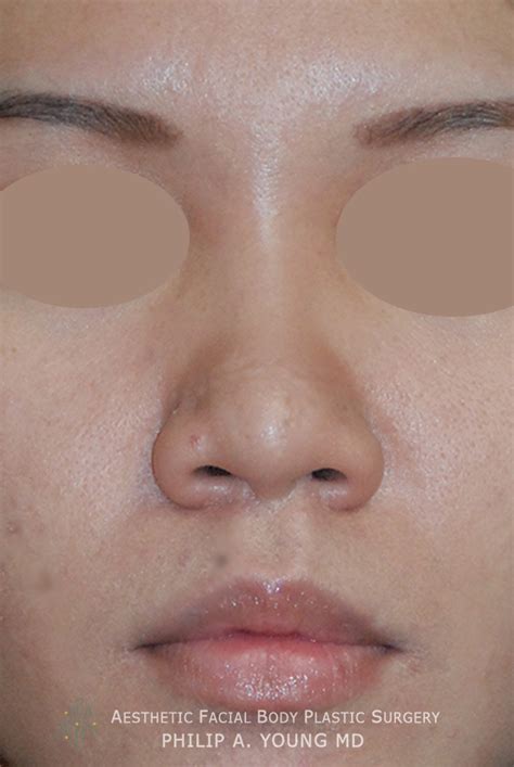 Asian Rhinoplasty Before And After Photos Seattle Bellevue