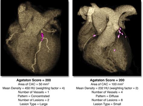 Coronary Artery Calcium Scoring Is It Time For A Change In Methodology