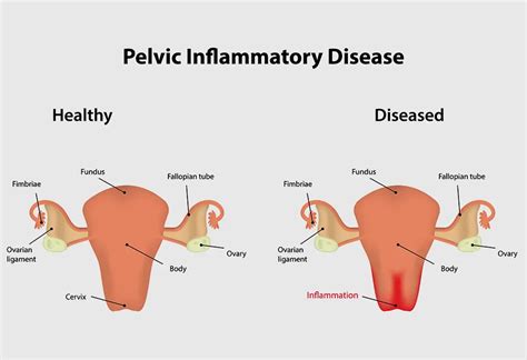 pelvic inflammatory diseases pid reasons symptoms treatment