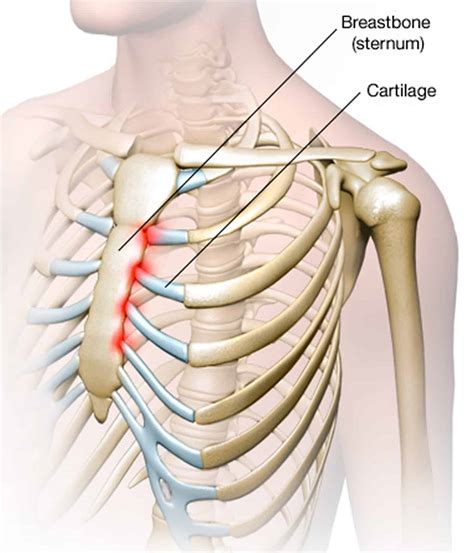 Costocondrite E Postura