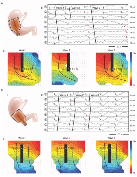 Example High Resolution Mapping Results Of Gastric Ablation 65°c 5 S