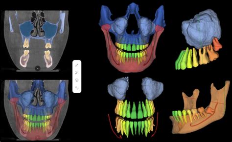 Automatic Labelling Identification And Segmentation Of Cone Beam